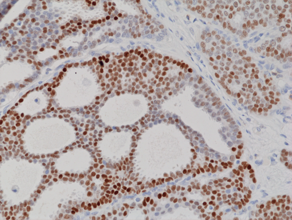 Anti-Progesterone Receptor (PR) Rabbit Monoclonal Antibody, Clone RM357: NEW CLONE with Improved Performance!