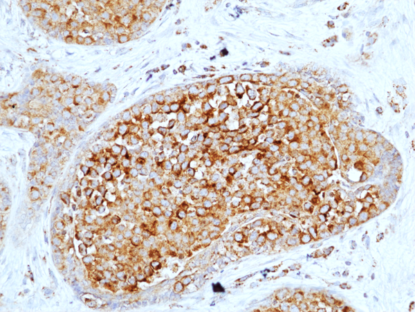Anti-Muc-1 (Mucin-1) (CA 15-3) (DF3) Rabbit Monoclonal Antibody, Clone RM489
